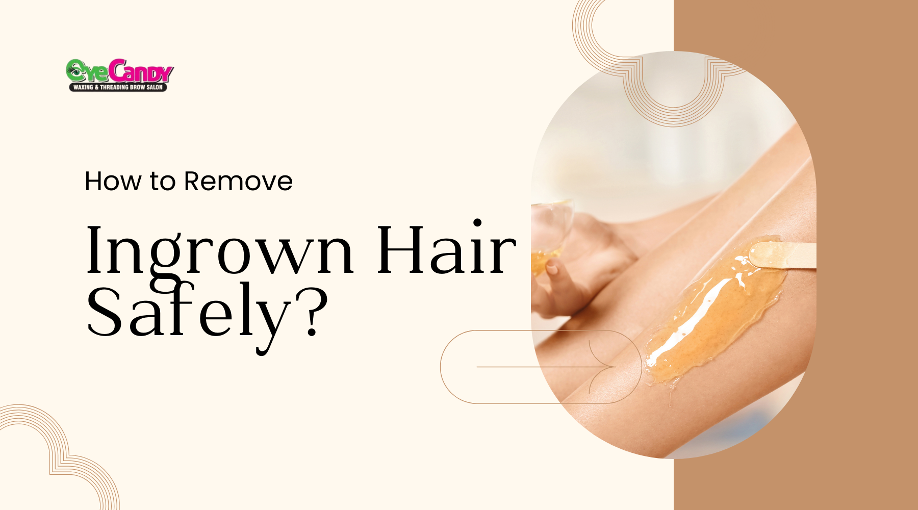 How to Remove Ingrown Hair Safely?